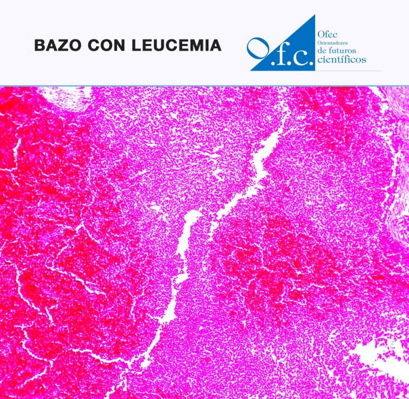 Bazo con leucemia