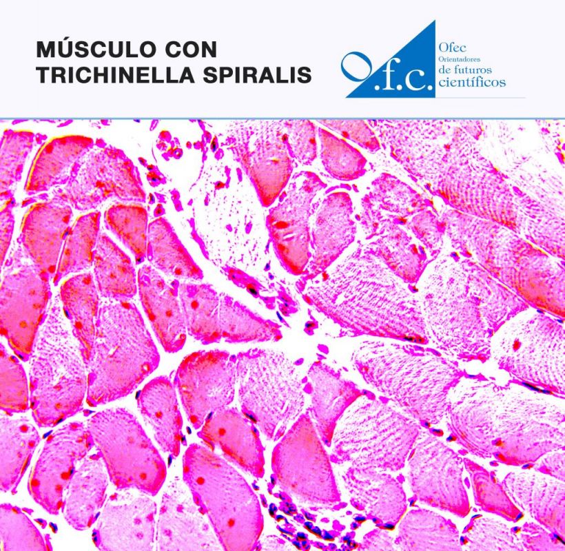 Músculo con trichinella spiralis