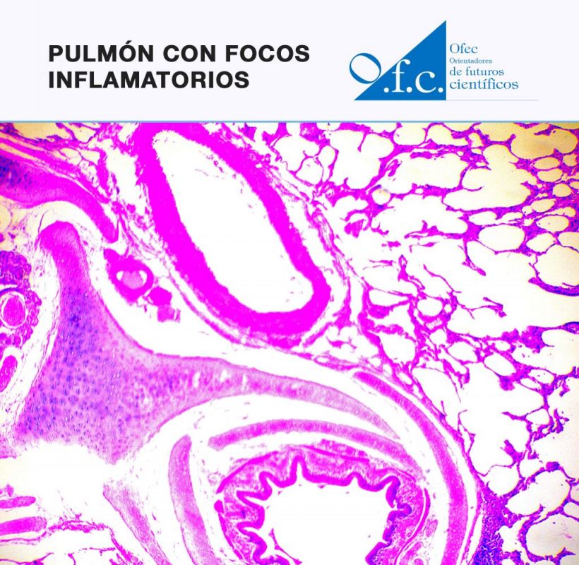 Pulmón con focos inflamatorios