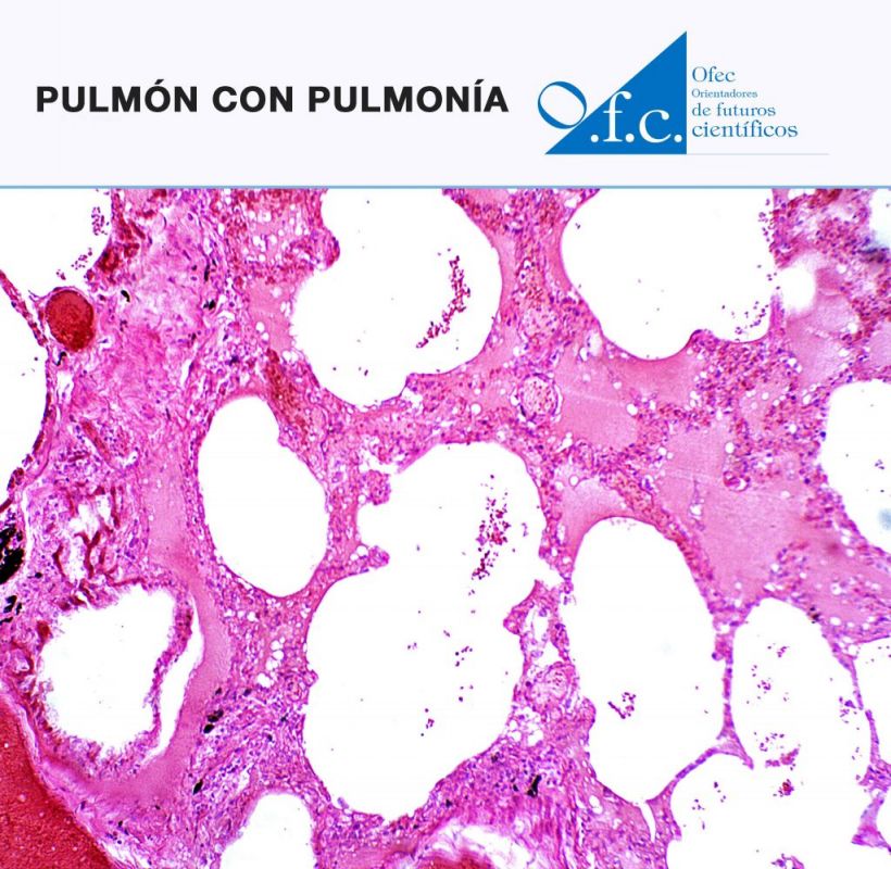 Pulmón con pulmonía