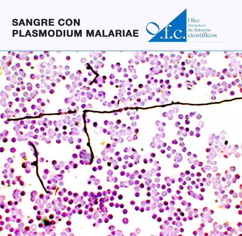 Sangre con  plasmodium malariae